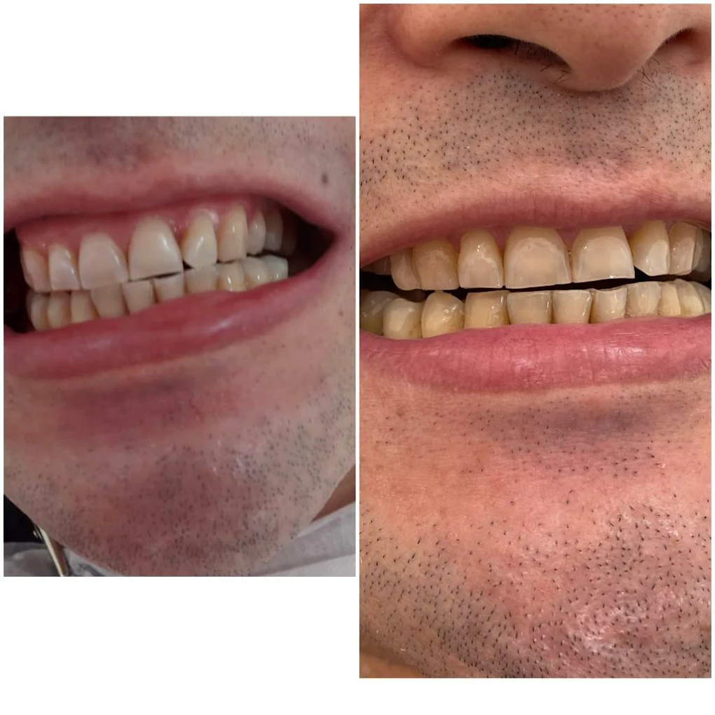 Resultado antes e depois de tratamento estético dental